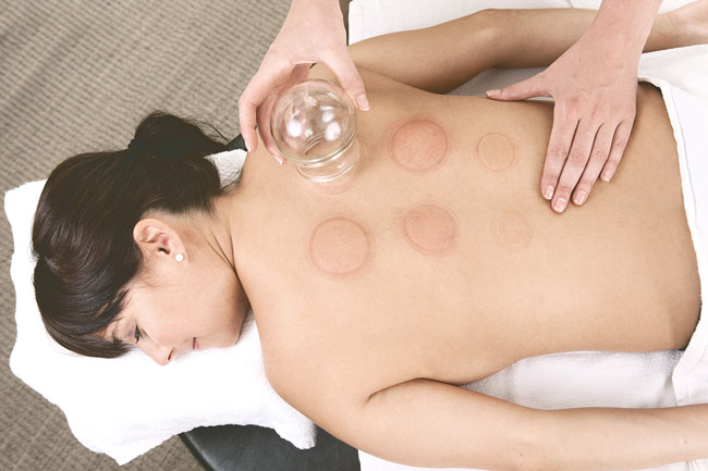 Cupping for Stress Relief