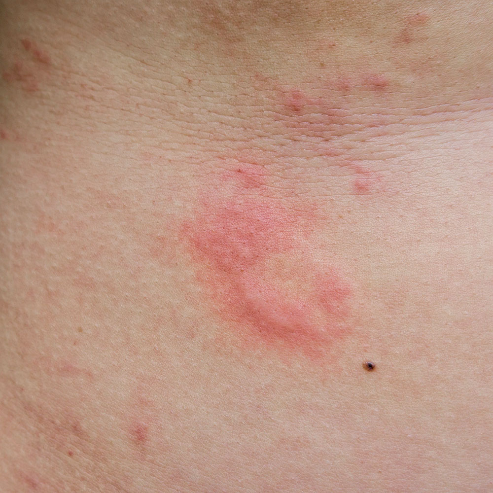 Hives Skin Condition